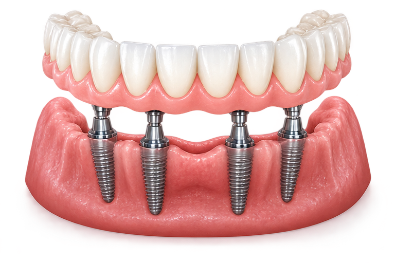 Zirconia full arch implant-supported teeth